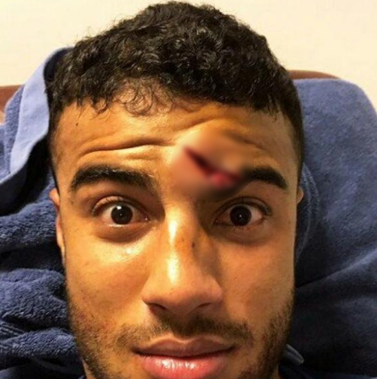 Rafinha đăng hình cận cảnh vết thương.