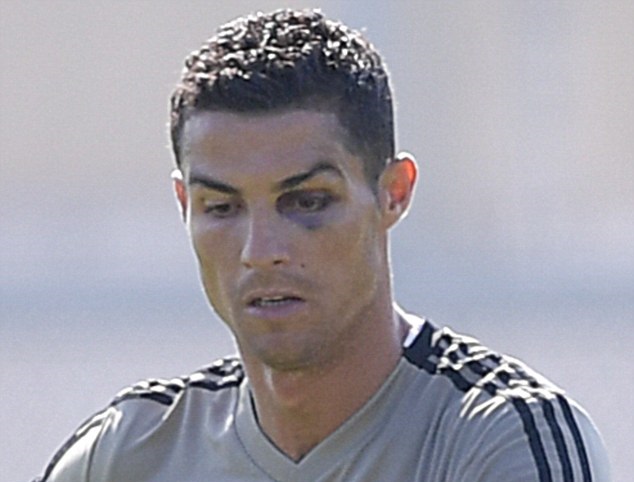 Ronaldo bất ngờ xuất hiện với quầng mắt thâm tím - Bóng Đá
