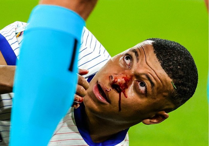 Mbappe đã bị vỡ mũi sau pha va chạm với Danso.