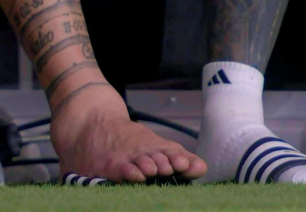 Cổ chân của Messi sưng tấy.