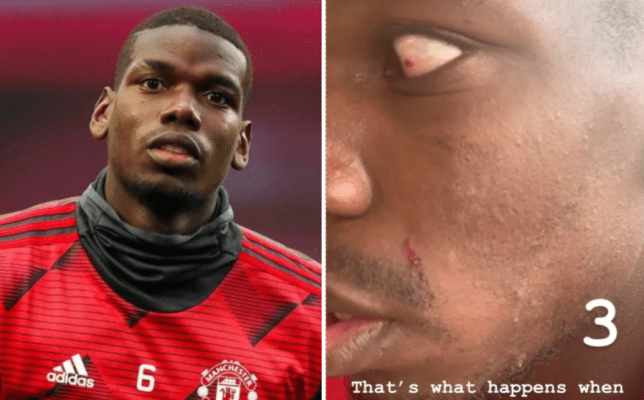 Paul Pogba shows off nasty cuts after being ‘destroyed’ by Manchester United teammate in training - Bóng Đá