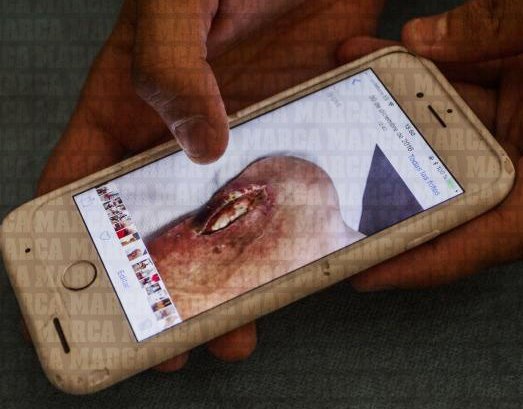 Ảnh bài viết Cận cảnh chấn thương gân bàn chân ghê rợn của Santi Cazorla