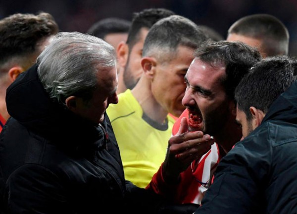 Ảnh bài viết Đối phương giật cùi chỏ, sao Atletico Madrid gãy 3 răng cửa