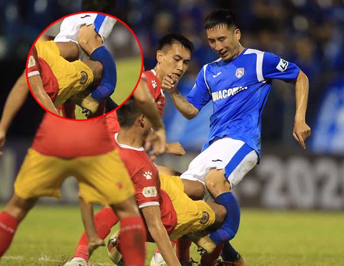 SỐC: "Iniesta xứ Mỏ" gãy gập xương ống đồng, vụt mất cơ hội lên tuyển