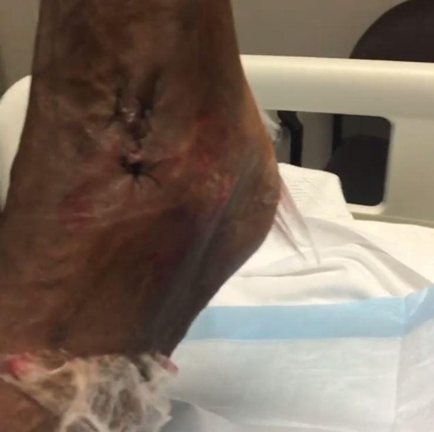 Jackson Martinez phờ phạc sau hai lần chữa chấn thương mắt cá - Bóng Đá