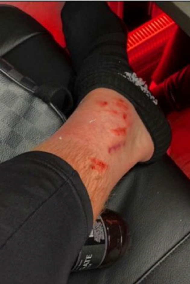 Scott McTominay shows off gruesome battle scars from Man Utd's win over Leeds - Bóng Đá