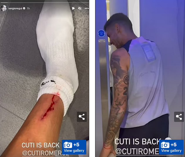 Sergio Reguilon shows off horror wound on his leg after he is left bleeding in pre-season training by tough-tackling Tottenham team-mate Cristian Romero - Bóng Đá