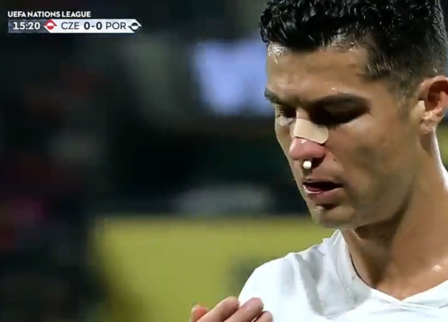Toàn cảnh sự cố khiến Ronaldo bê bết máu - Bóng Đá