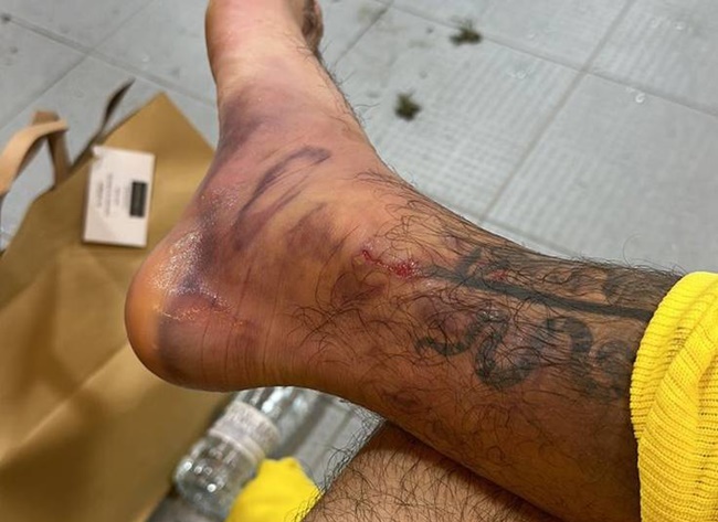 Villarreal star Alex Baena puts out gruesome photo of battered foot after Lucas Vazquez challenge - Bóng Đá