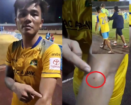 Ngoại binh Khánh Hòa cắn vào tay cầu thủ SLNA?