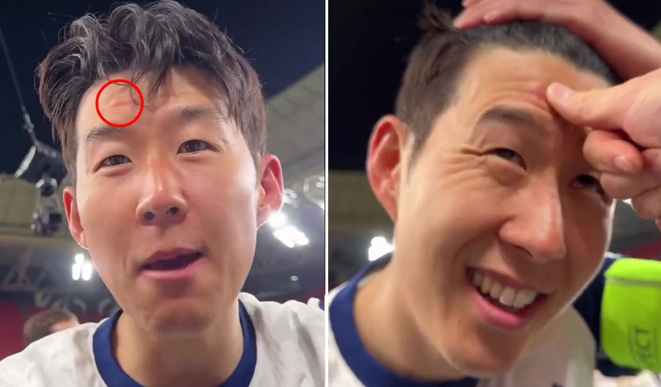 Trán của Son Heung-min bị sưng khi đập phải chiếc cúp Europa League.