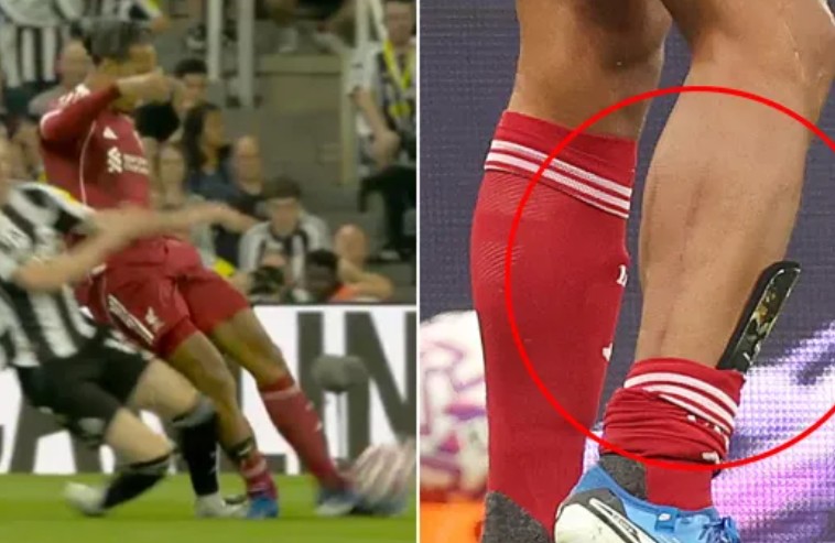 Chân của Virgil Van Dijk hằn rõ 2 vết xước sau pha phạm lỗi của Anthony Gordon.