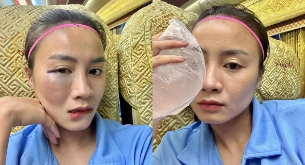 Hoàng Thị Loan bị sưng mặt sau trận thắng của Hà Nội.