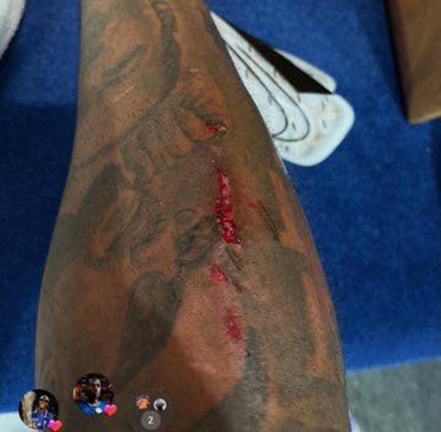 Hình ảnh chấn thương được Reece James đăng lên trang cá nhân.