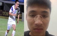 Cầu thủ Đắk Lắk tố bị cựu tiền đạo U23 Việt Nam đấm gãy sống mũi