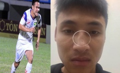 Cầu thủ Đắk Lắk tố bị cựu tiền đạo U23 Việt Nam đấm gãy sống mũi